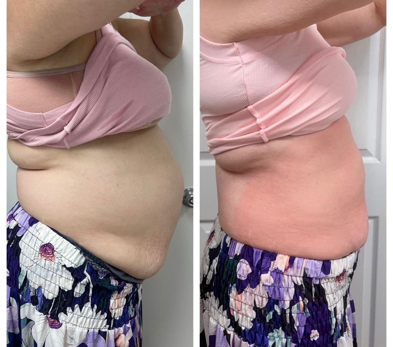 Before and after weight loss treatment at M.A Esthetics